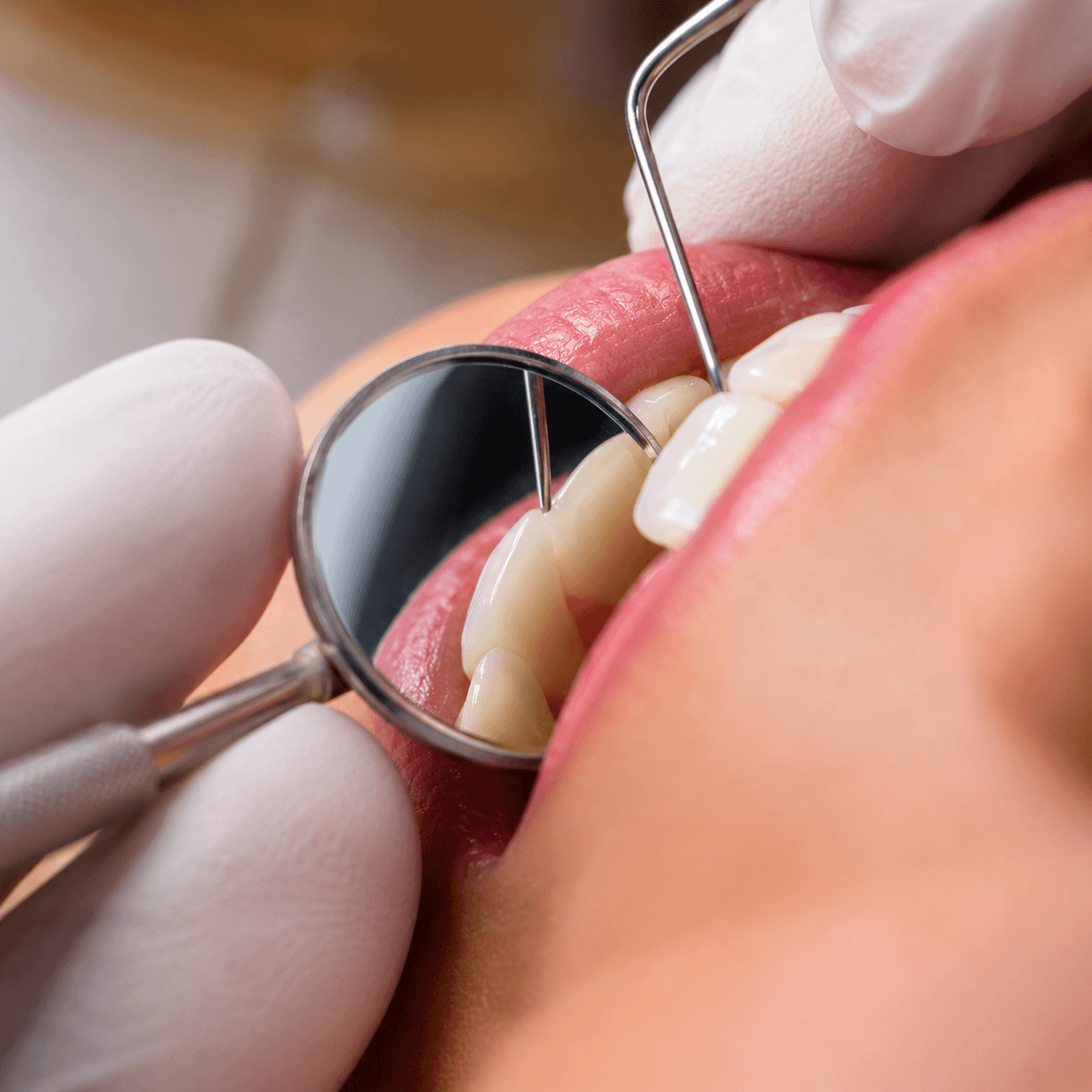 Endodontic Root Therapy